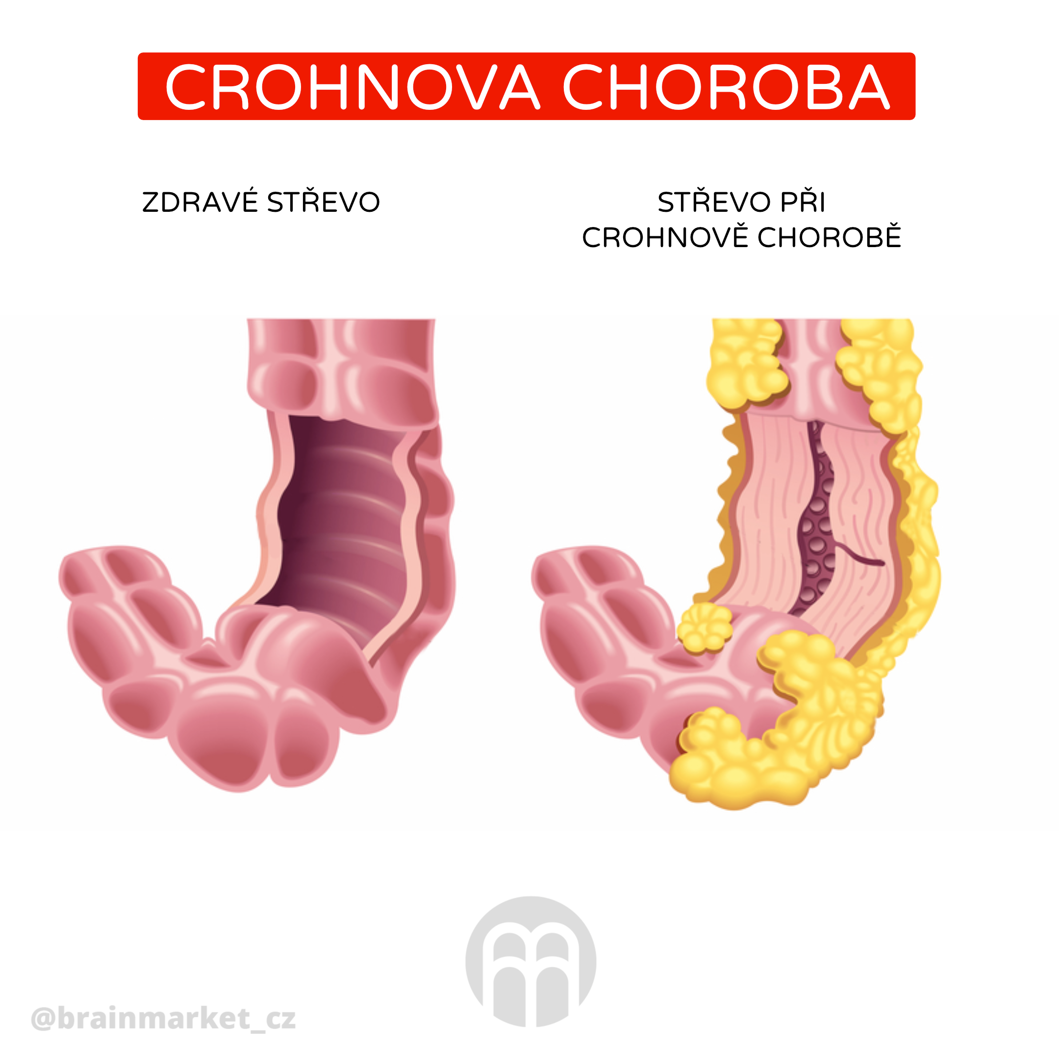 Crohnova nemoc_infografika_cz